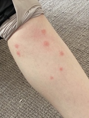 To ask for help about these bites