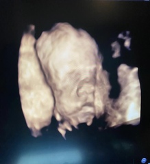 Did doctor miss cleft lip on 25 week scan?