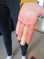 White painful fingers and toes