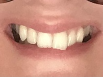 Invisalign. A few potentially stupid questions