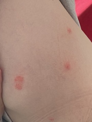 To ask for help about these bites