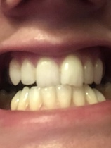 Invisalign. A few potentially stupid questions