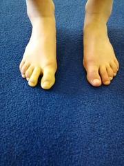 White painful fingers and toes