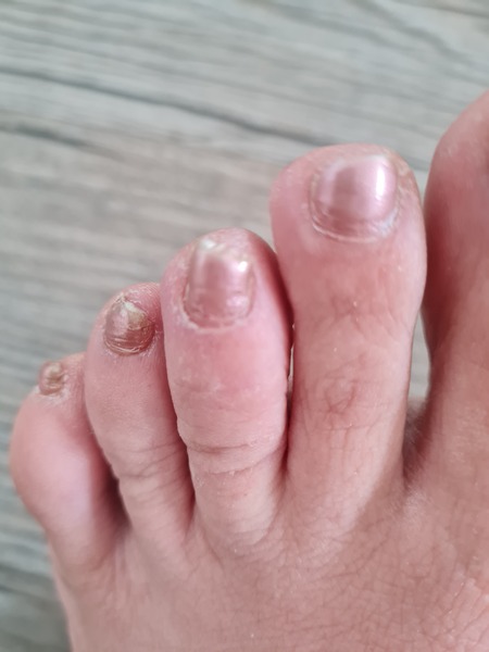 Anyone got idea what these dry patches on my foot could be?