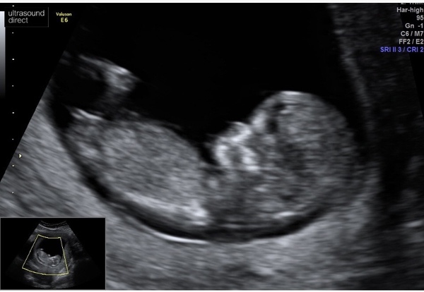 Boy or girl pregnancy opposite symptoms - experience please