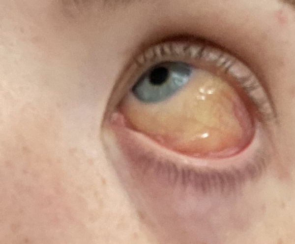 TMI - gunky eye picture