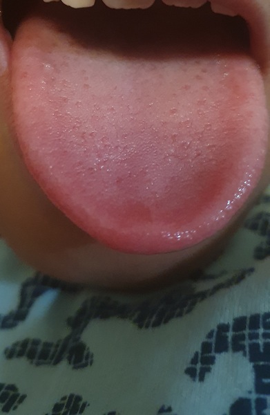7 year old with itchy tongue