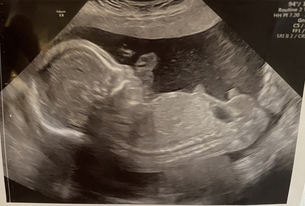 20 Week Scan - Weren't Going to Find Out But Think It Shows?!