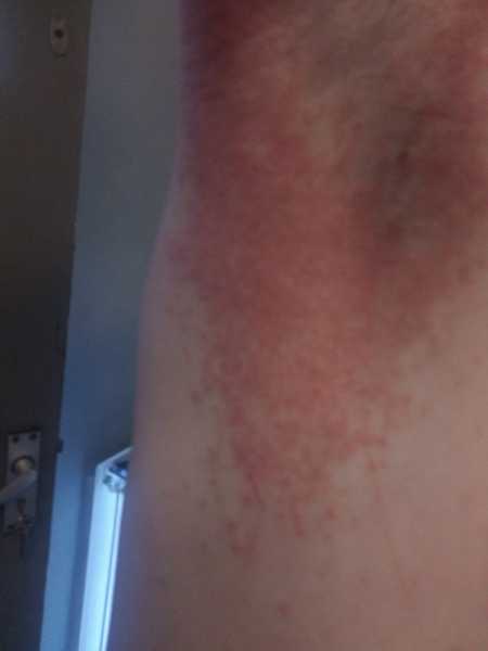 Can you help me identify a skin condition??