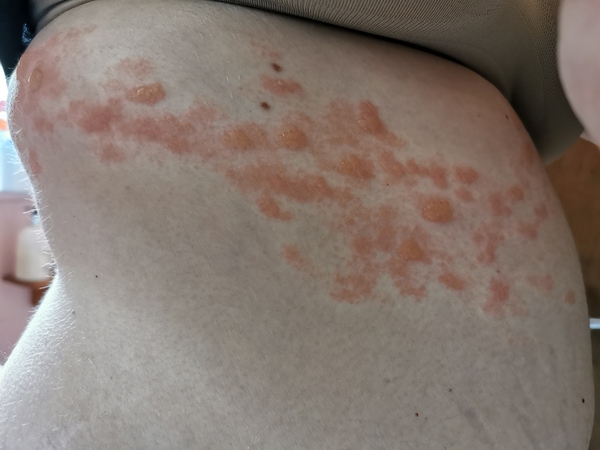 Shingles. Do you want to see?