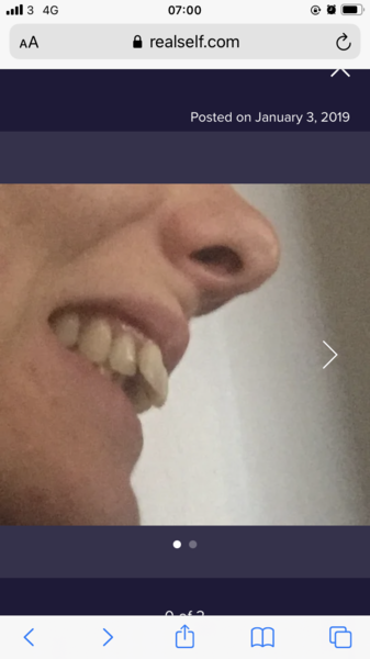 Invisalign for overjet