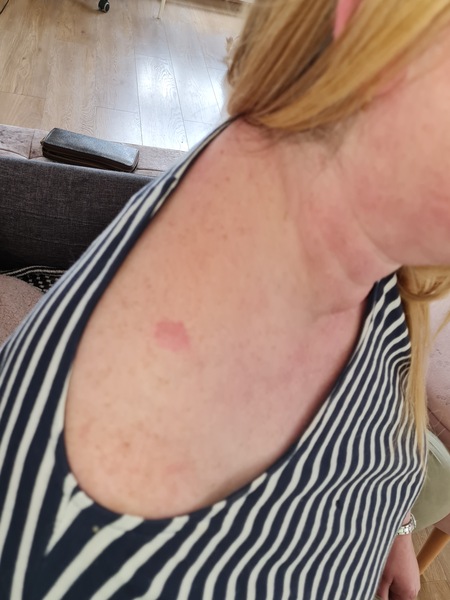 What could this lump be- not a bite?
