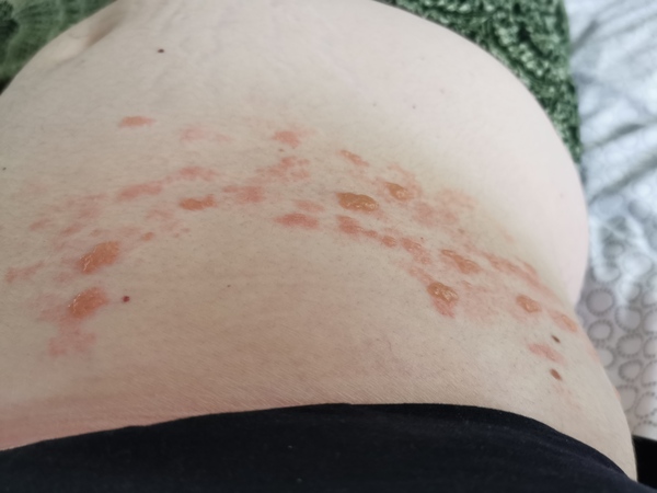 Shingles. Do you want to see?