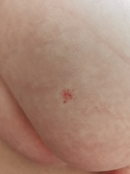 Birth mark?