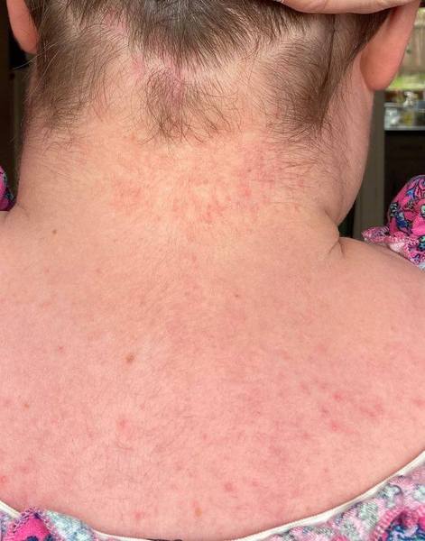 any armchair diagnosis for a rash? (photos)
