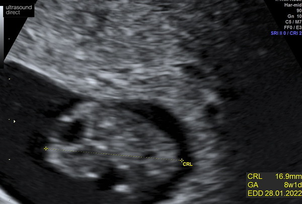 4 Weeks, First Pregnancy