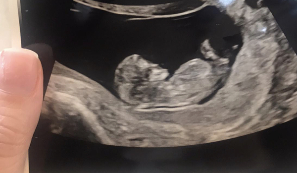 Nasal bone visible? Opinions appreciated!!