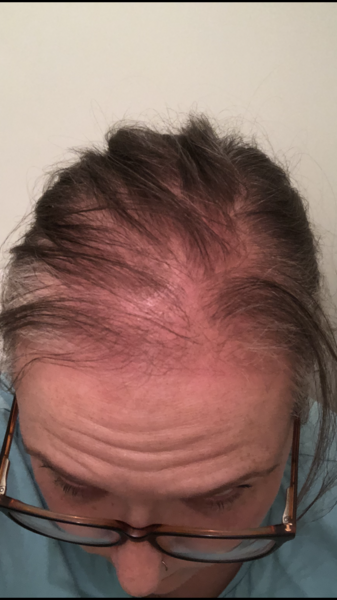 Hair topper wearers advice please