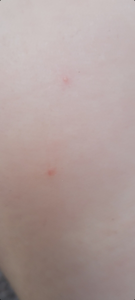 Does this look like chicken pox?