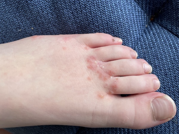 can anyone help? Weird rash on DS foot...