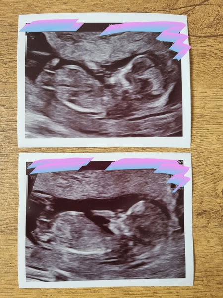 Nub theory/12wk scan guesses..