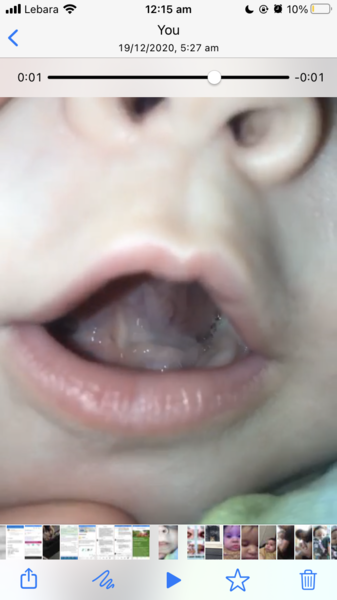 Posterior tongue tie?