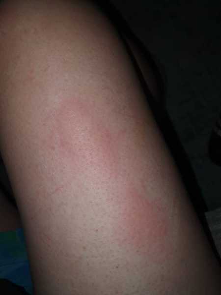 Frostbite from little moons!!