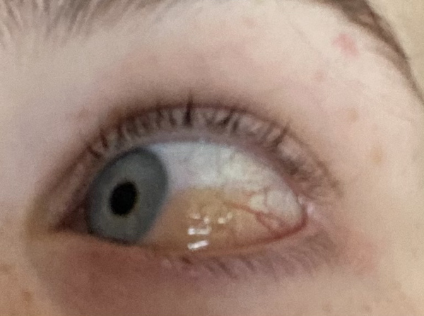 TMI - gunky eye picture