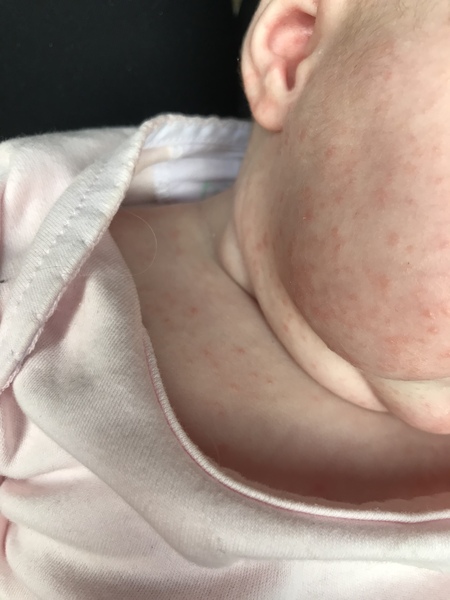 Does this rash on my newborn look familiar to anyone?