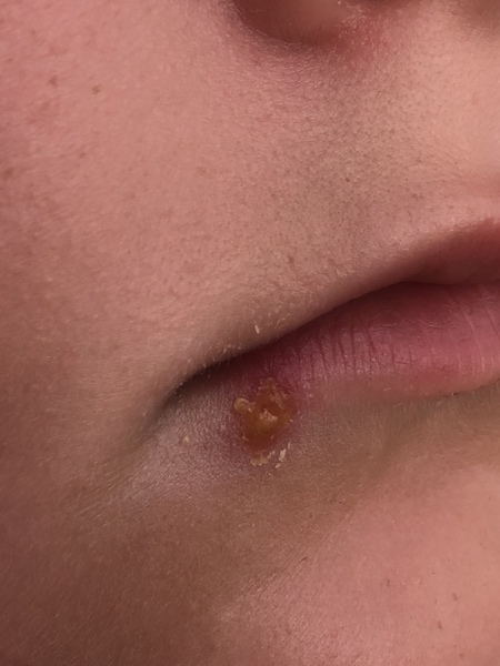 Cold sore on my DD8?