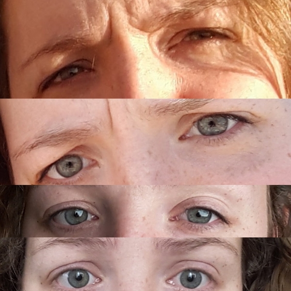 is eyelid surgery the only way to fix this?