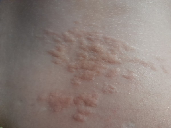 Rash on 15yr old