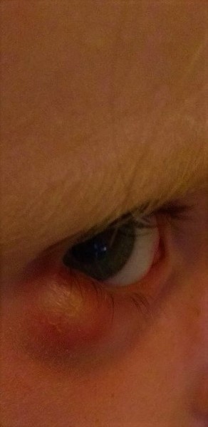 eye swelling