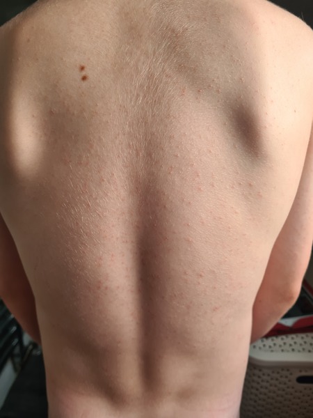 Rash.....