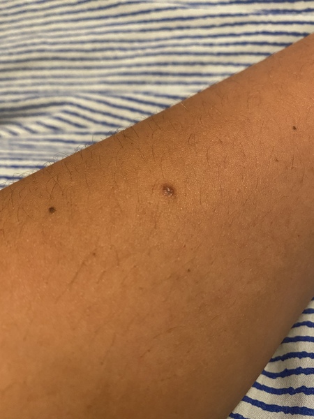 Weird new mole
