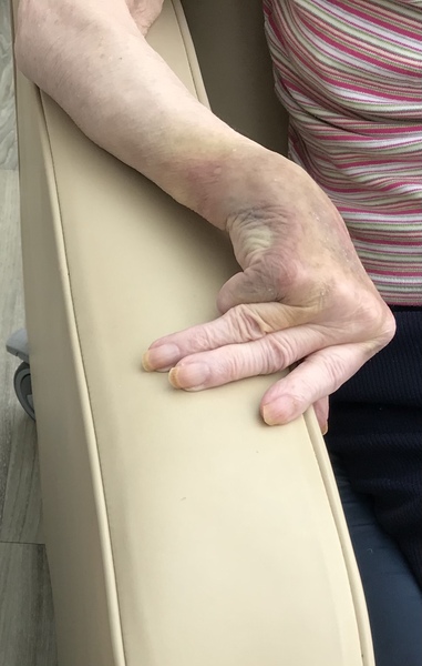 Elderly aunts bruised hand