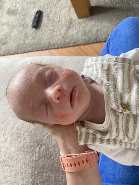 Baby acne?