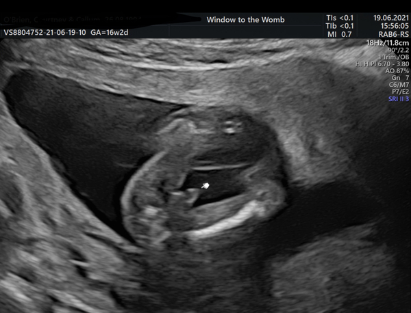 Gender confirmation!