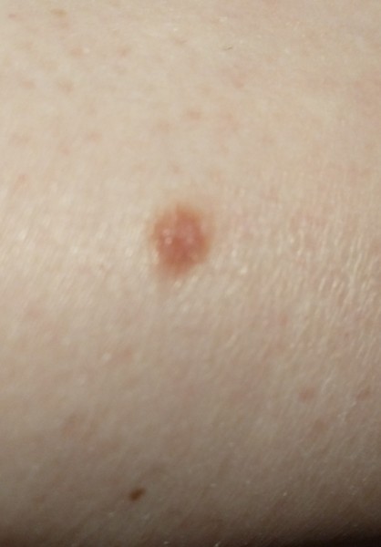 What’s on my DD’s leg?