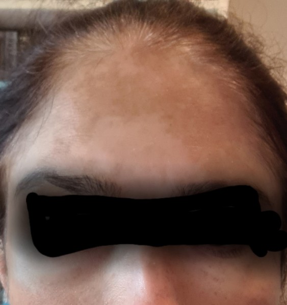Hyperpigmentation or vitiligo - help please!