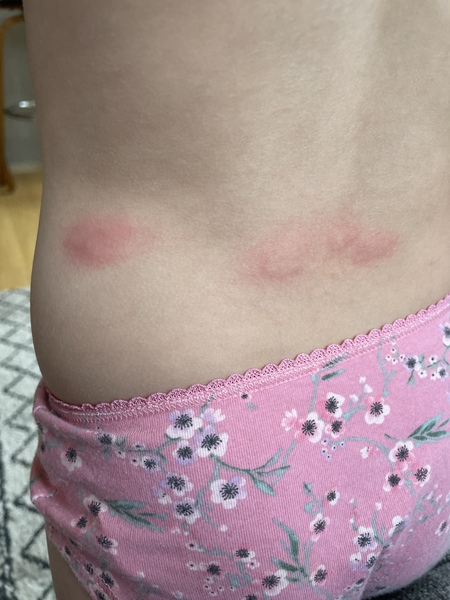 Are these bites on dds back anything to worry about?