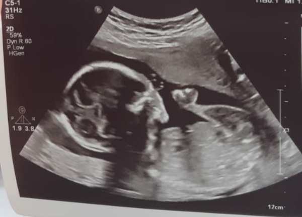 Help me figure out my scan? 20 weeks.