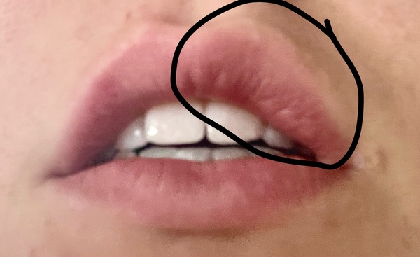 Inflamed lip on and off throughout the day ?