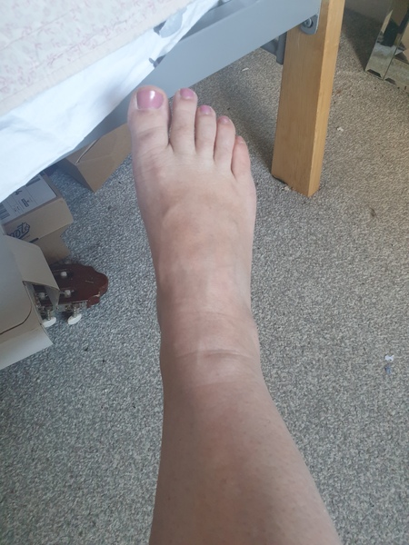 Mosquito bite and allergic reactions