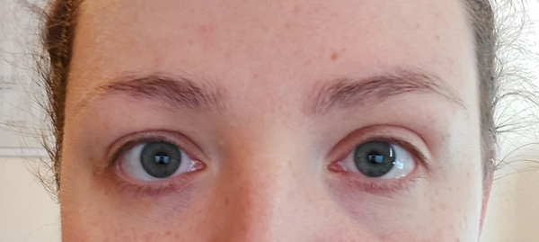 is eyelid surgery the only way to fix this?