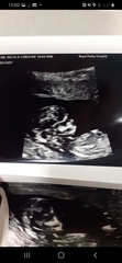 Baby scan 12 week