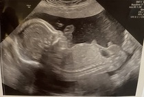 Anyone else have a 20 week scan like this??