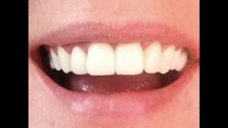 Adult braces