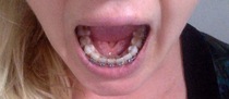 Adult braces