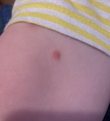 What’s on my DD’s leg?